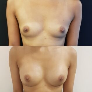 Ballerina Breast Augmentation Before and After