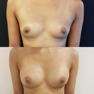 Ballerina Breast Augmentation Before and After