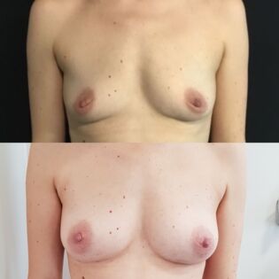 Ballerina Breast Augmentation Before and After