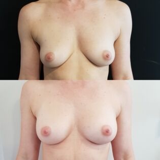 Ballerina Breast Augmentation Before and After