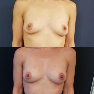Ballerina Breast Augmentation Before and After
