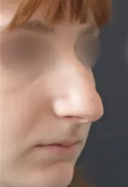 TJ Before Rhinoplasty Three Quarter View