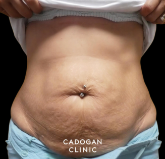 Cadogan Clinic PT Abdo Before