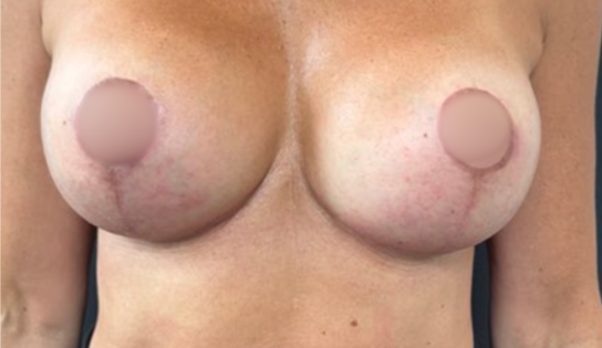 WVN After Mastopexy & Implant Exchange Front