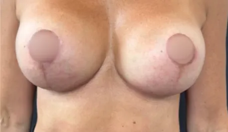 WVN After Mastopexy & Implant Exchange Front