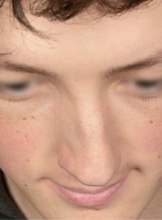 AN Rhinoplasty Before