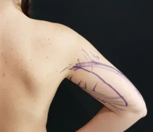 HS Arm Lipo 1 Before Back