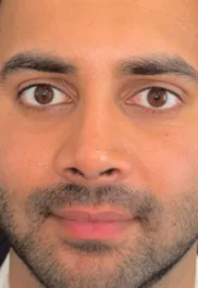 SP After Septorhinoplasty Front