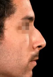 MA Septorhinoplasty Before Side