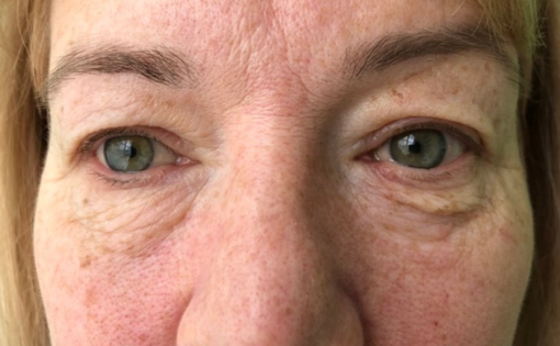 GG Before Upper and Lower Blepharoplasty