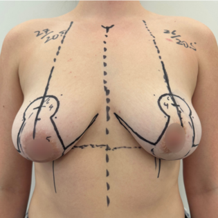 Breast Lift WVN Before
