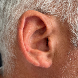 MK Ear Reduction After