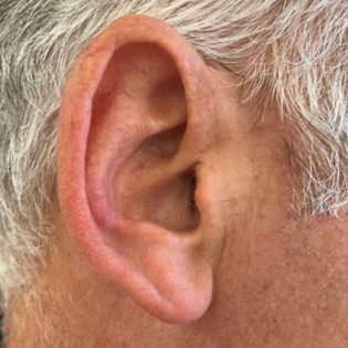 MK Ear Reduction Before