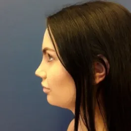 Unknown After Rhinoplasty