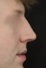 TJ Before Male Rhinoplasty Profile