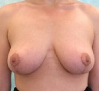 GG After Mastopexy