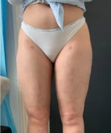 OT Inner Thigh Liposuction 1 After Front