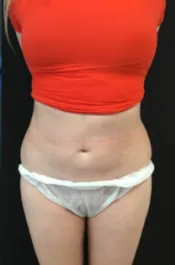 HS Abdomen Lipo After 1 Front