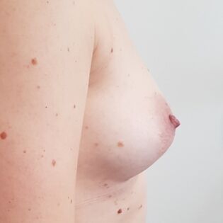 Cadogan Clinic HS FT Breast After