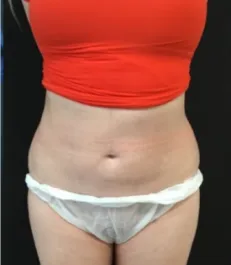 HS Abdomen Liposuction After 1 Front
