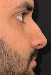SP Before Septorhinoplasty Profile