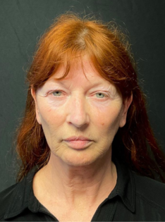 KY Before Deep Plane Face and Neck Lift, Brow Lift, Lip Lift, Bleph & Fat Transfer