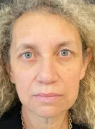 KY Before Deep Plane Face and Neck Lift, Brow Lift