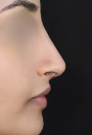 TJ After Rhinoplasty Profile
