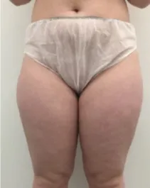OT Inner Thigh Liposuction Before 1 Front
