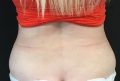 HS Flanks Liposuction After 2 Back