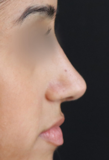 TJ After Septorhinoplasty