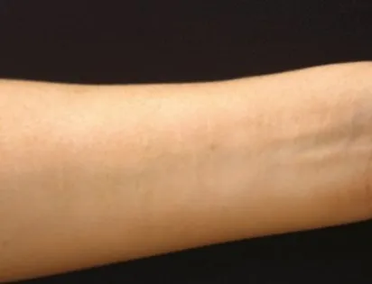 melanotan 2 reddit Me 2 years ago vs me 2 weeks on mt2 : r/Melanotan2