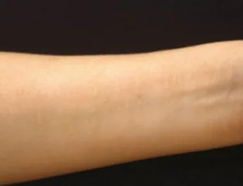 NAH White Scar Treatment Arm After