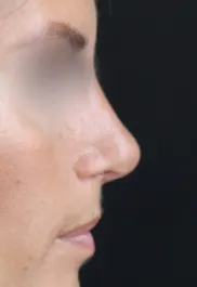 TJ After Rhinoplasty Profile