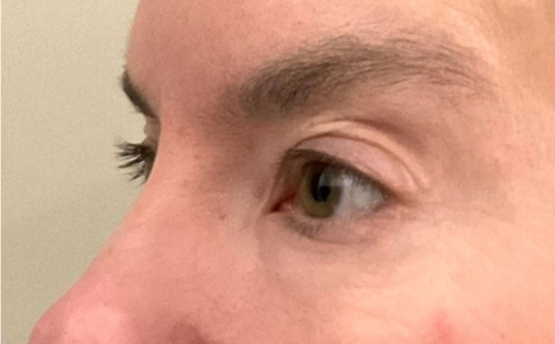 KY After Upper Blepharoplasty Three Quarters