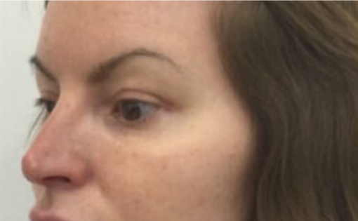 EH After Upper Blepharoplasty