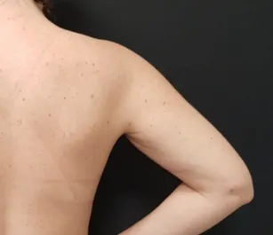 HS Arm Lipo 1 After Back