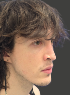 AN Rhinoplasty After