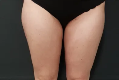 HS Inner Thigh Liposuction After 1 Front