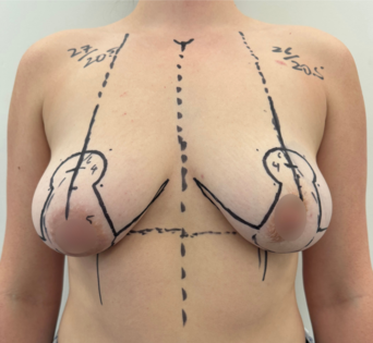 WVN Before Mastopexy