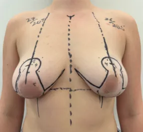 WVN Before Mastopexy