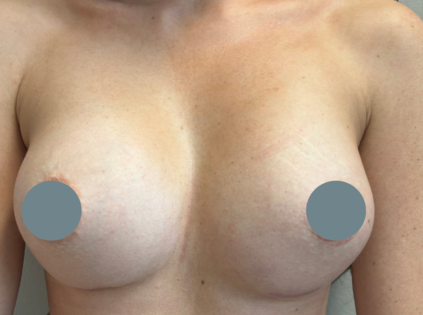 SSJ Breast Augmentation After