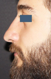 TT Before Nose Tip Rhinoplasty