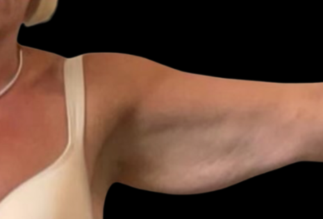 Cadogan Clinic Arm Lift PT Before