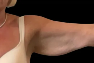 Cadogan Clinic Arm Lift PT Before