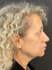 KY Before Deep Plane Face and Neck Lift, Brow Lift