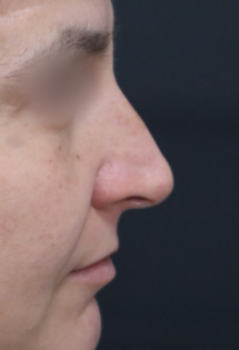 TJ Before Septorhinoplasty