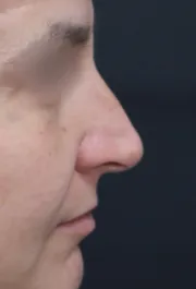 TJ Before Septorhinoplasty