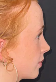 SP Rhinoplasty After Side