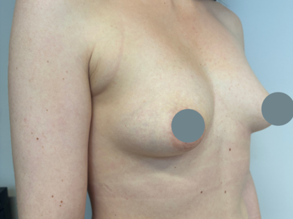 SSJ Breast Augmentation Before
